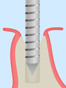 当院のインプラント治療について
