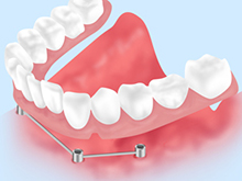 当院のインプラント治療について