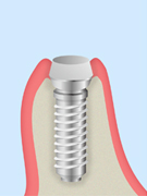 当院のインプラント治療について