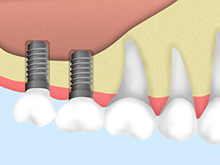 当院のインプラント治療について