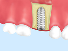 当院のインプラント治療について
