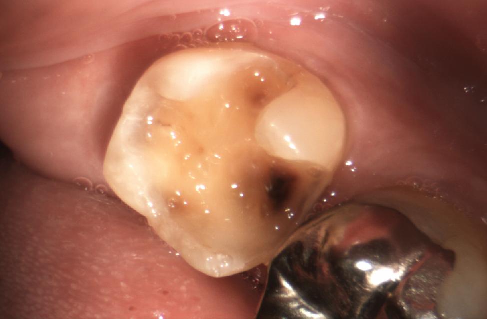 このような古い詰め物や着色、虫歯の症例にコンポジットレジンという小さい虫歯に保険の治療として使う、セラミックが7-8割、樹脂が2割のレジンを歯に直接接着させて、歯の形を再構築する治療を、特殊技術で行います。