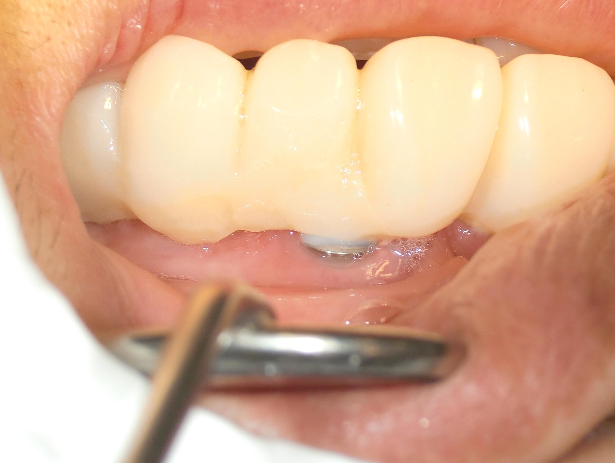 インプラント　長期奨励　総入れ歯　総義歯　インプラント周囲炎