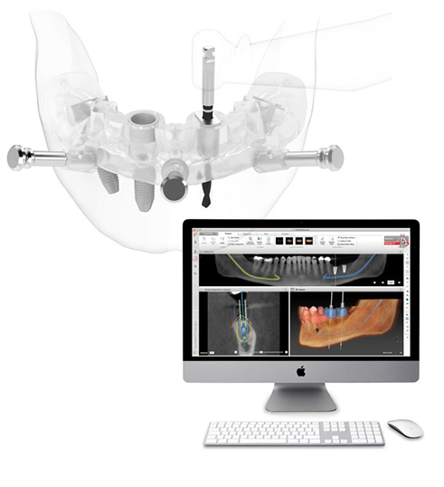 約30年のキャリアとコンピュータ支援によるデジタルインプラント治療