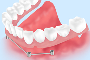 入れ歯を支えるインプラント入れ歯