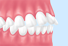 上顎前突（じょうがくぜんとつ）