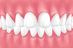 空隙歯列（くうげきしれつ）